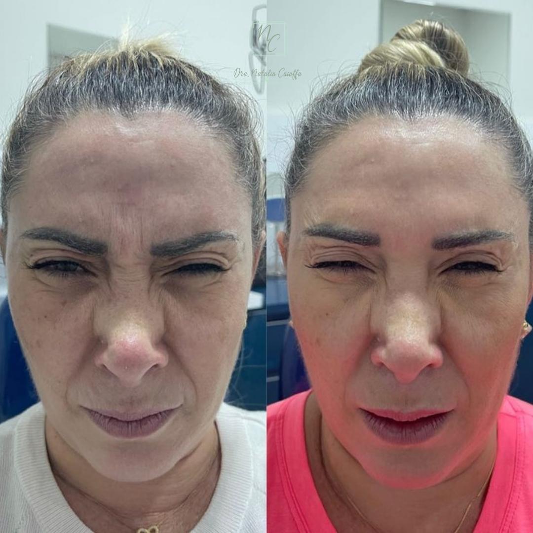 Dra. Natália Caiaffa Botox #2.1.E