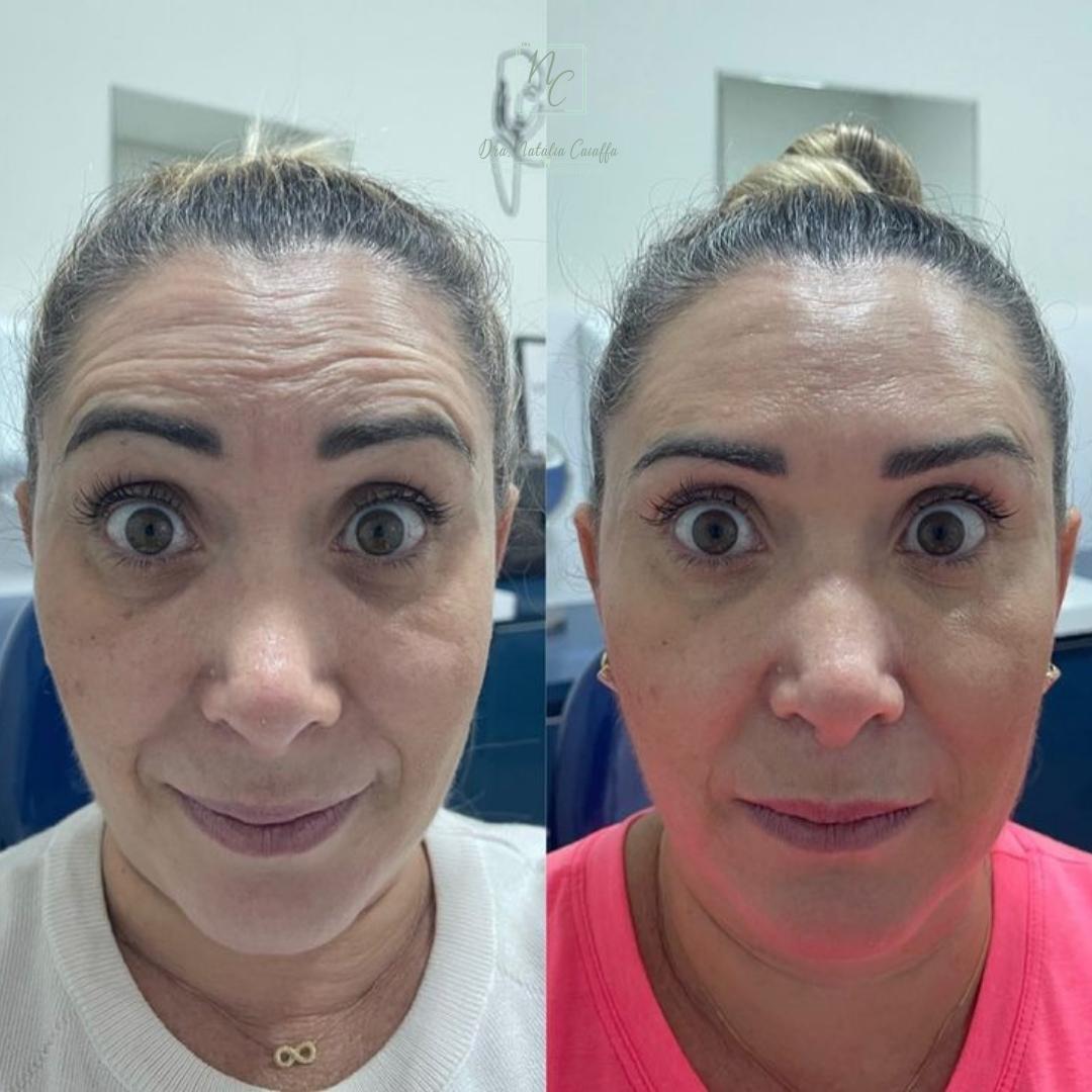 Dra. Natália Caiaffa Botox #2.2.E